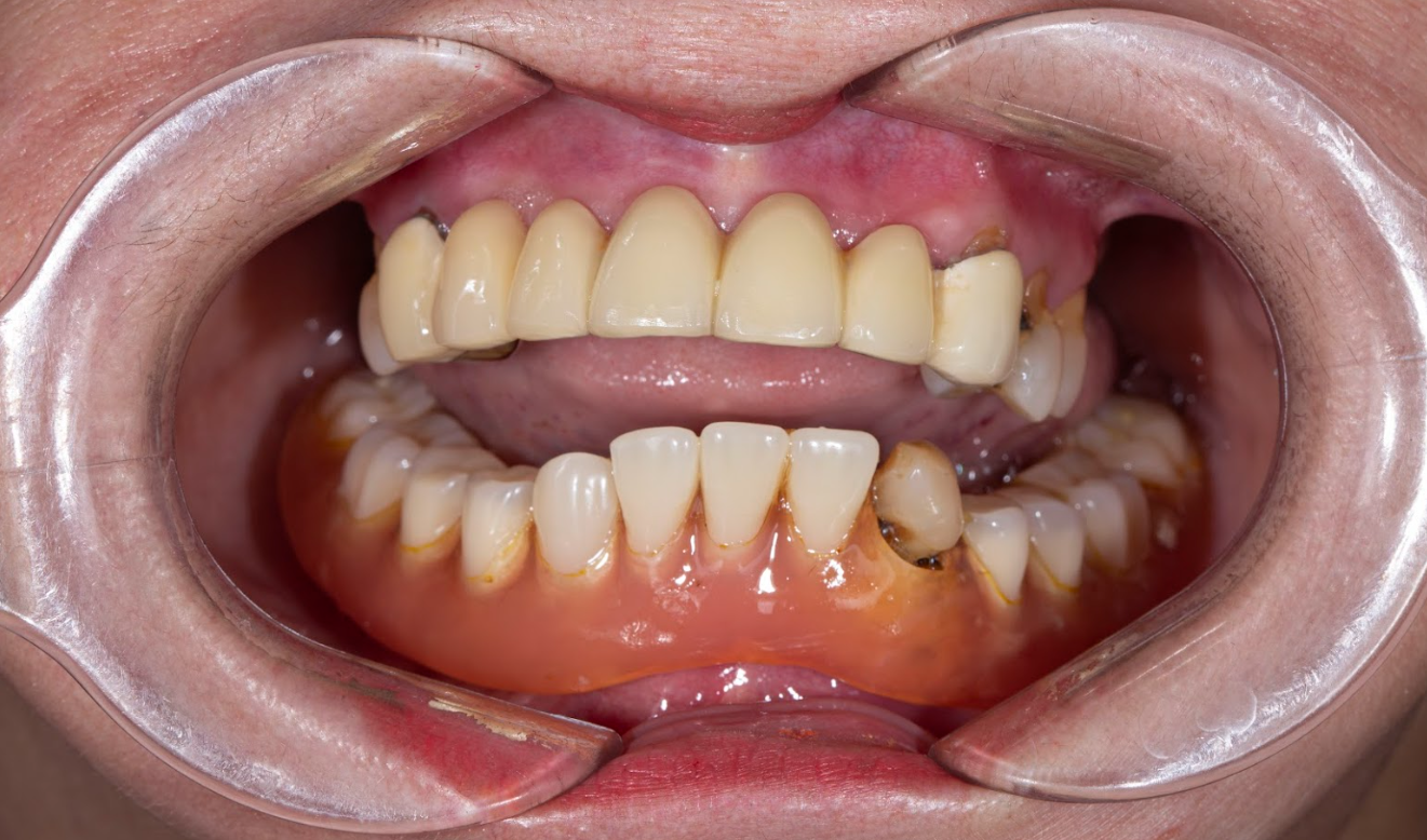 Sử dụng hàm giả tháo lắp trở thành 1 trong những phương pháp phục hình răng mất cổ điển