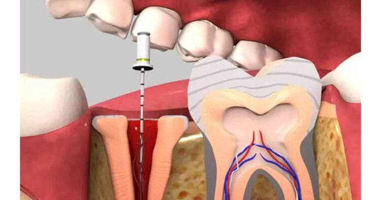 Răng đã chữa tủy có nên bọc sứ không?
