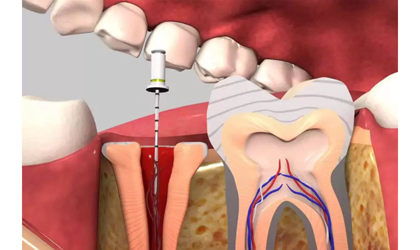 Răng đã chữa tủy có nên bọc sứ không?