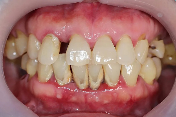 5 nguyên tắc chăm sóc sau điều trị nha chu cần ghi nhớ