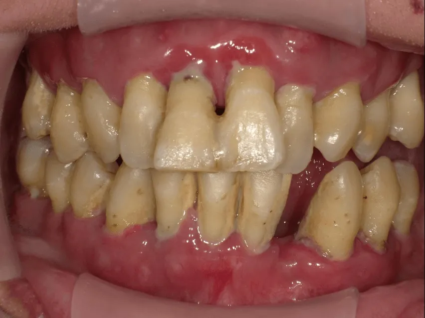 Điều trị nha chu tại Nha khoa Olympia có gì đặc biệt?