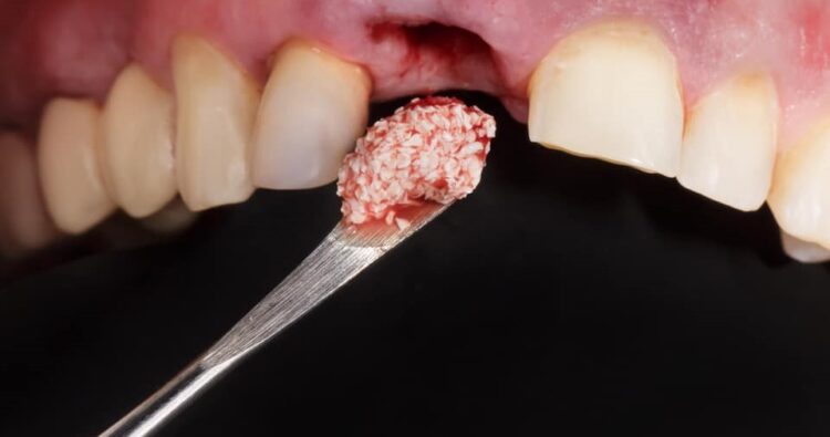 Các phương pháp ghép xương phổ biến hiện nay