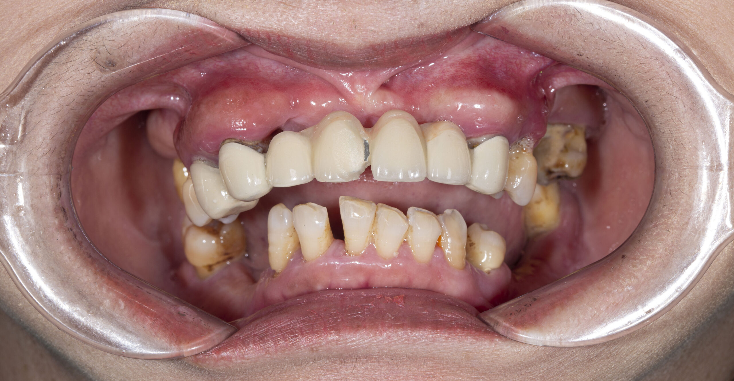 Hậu quả từ việc dùng cầu răng sứ