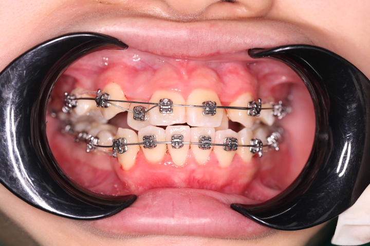 Niềng răng có đau không? Đau mấy ngày?