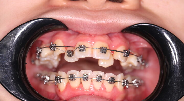 Nhược điểm của niềng răng mắc cài