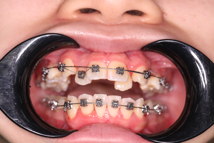 Nhược điểm của niềng răng mắc cài