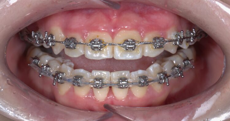 Niềng răng có đau không?