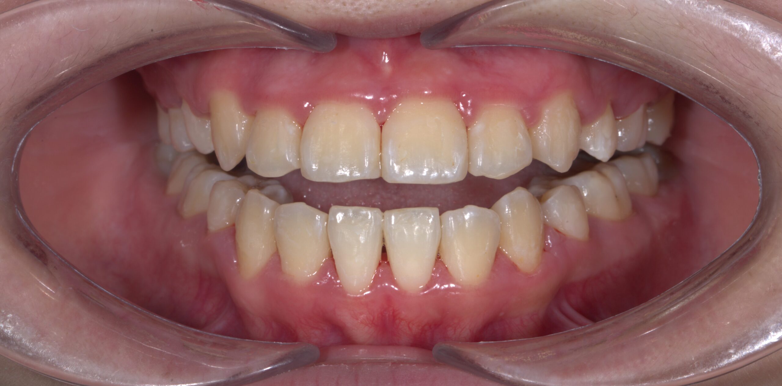 2 năm – không chỉ để thay đổi một hàm răng