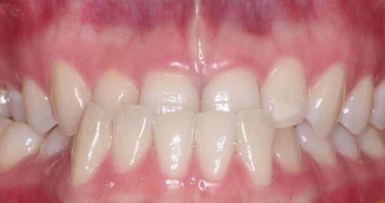 Khớp cắn ngược ở trẻ em là gì?