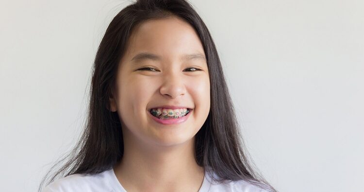 niềng răng cho trẻ em