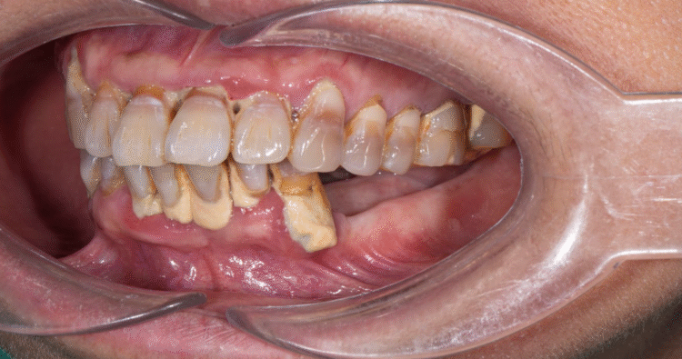 Người mất răng lâu năm gặp nhiều vấn đề