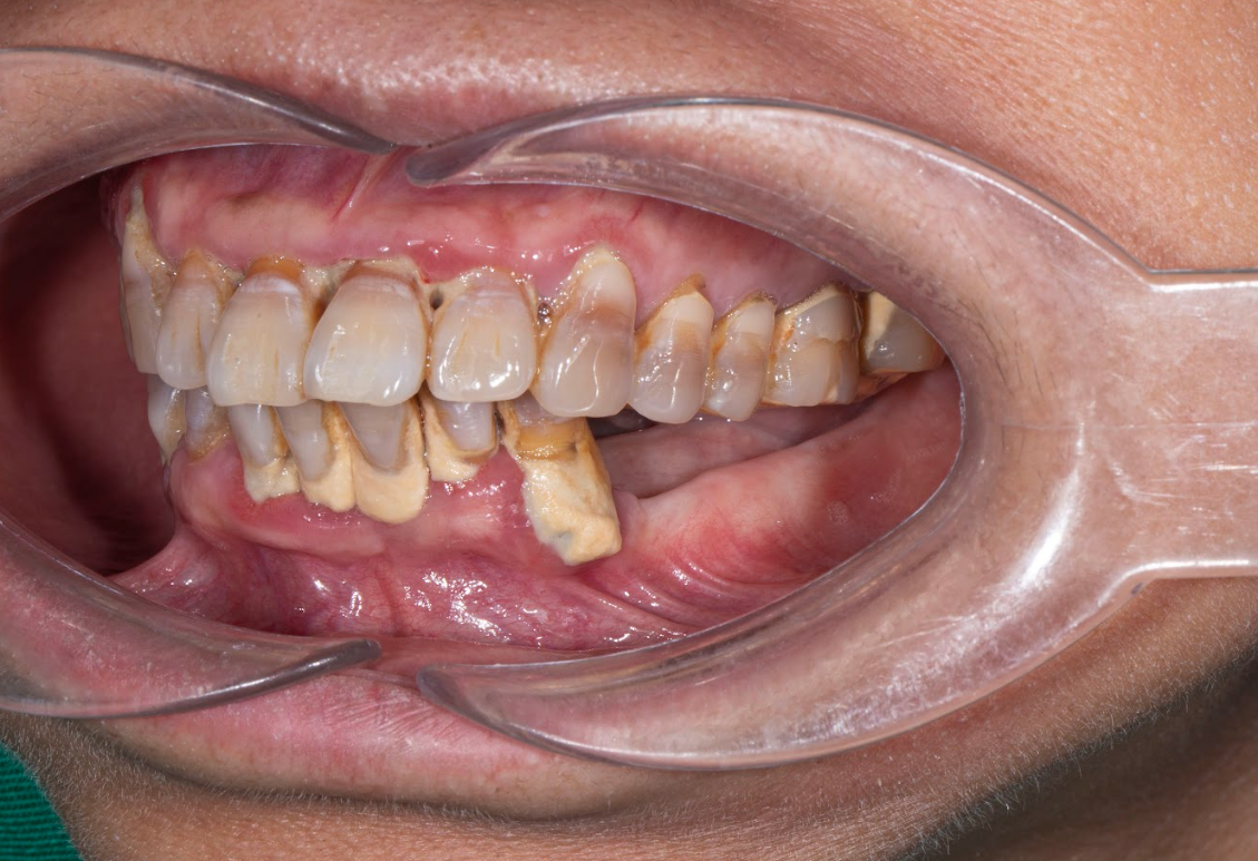 Người mất răng lâu năm gặp nhiều vấn đề