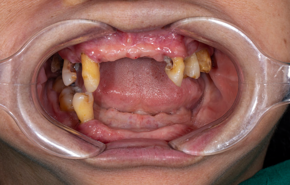 Trồng răng cho người mất răng lâu năm – Có cần ghép xương?