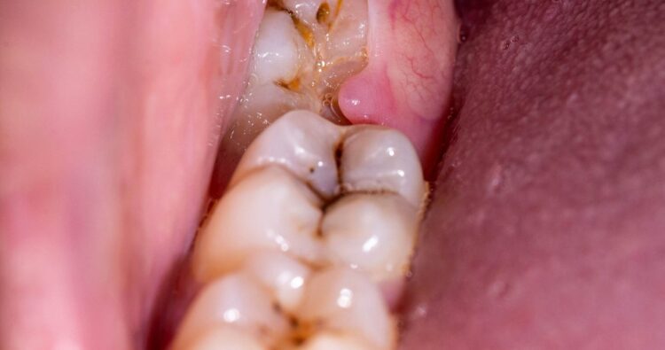 Răng khôn mọc muộn – Vấn đề thường bị xem nhẹ ở người trưởng thành