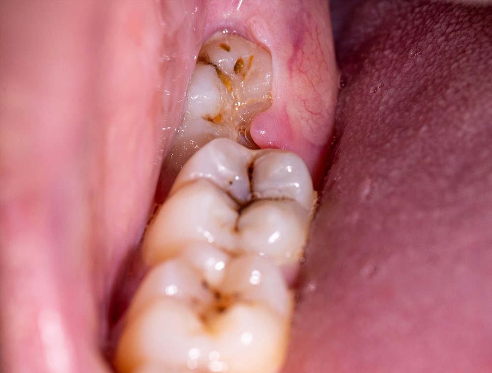 Răng khôn mọc muộn – Vấn đề thường bị xem nhẹ ở người trưởng thành