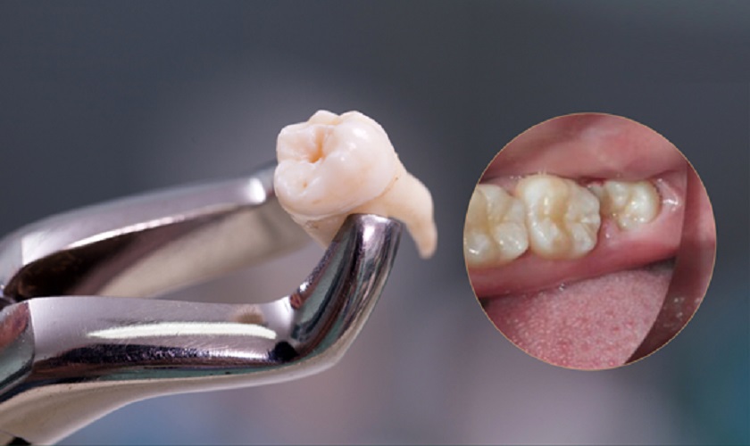 Nhổ răng khôn có nguy hiểm không? – Câu hỏi khiến nhiều người lo lắng
