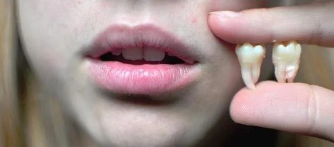 Nhổ 2 răng khôn cùng lúc – Lợi hay hại?