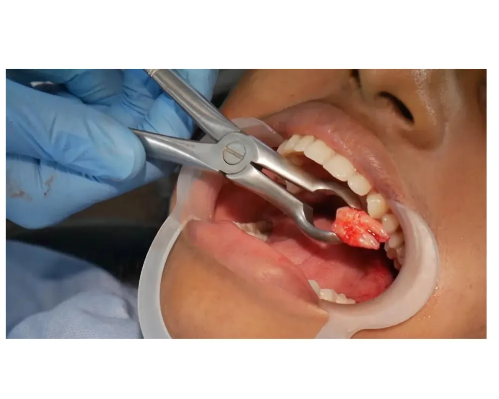 Mẹo giúp răng khôn lành nhanh – Bác sĩ Olympia chia sẻ