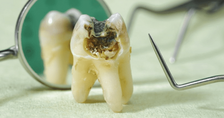 Tại sao răng sâu không nên trì hoãn điều trị?
