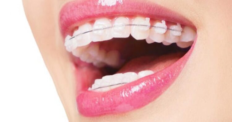 Niềng răng mắc cài sứ – thẩm mỹ hơn nhưng cần giữ gìn