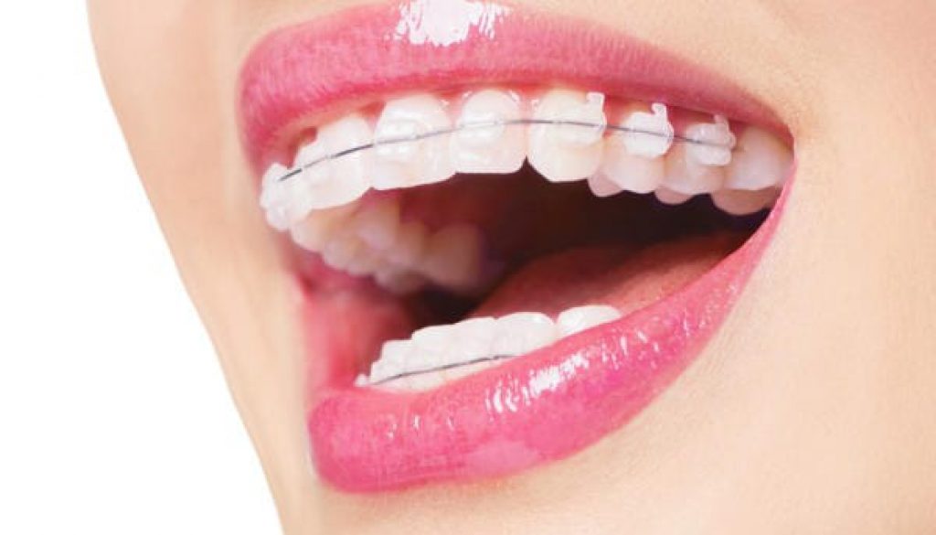 Niềng răng mắc cài sứ – thẩm mỹ hơn nhưng cần giữ gìn