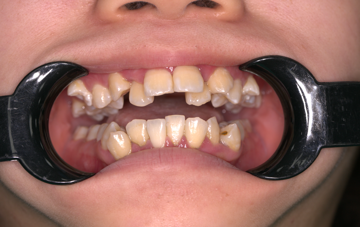 Khớp cắn hạng II