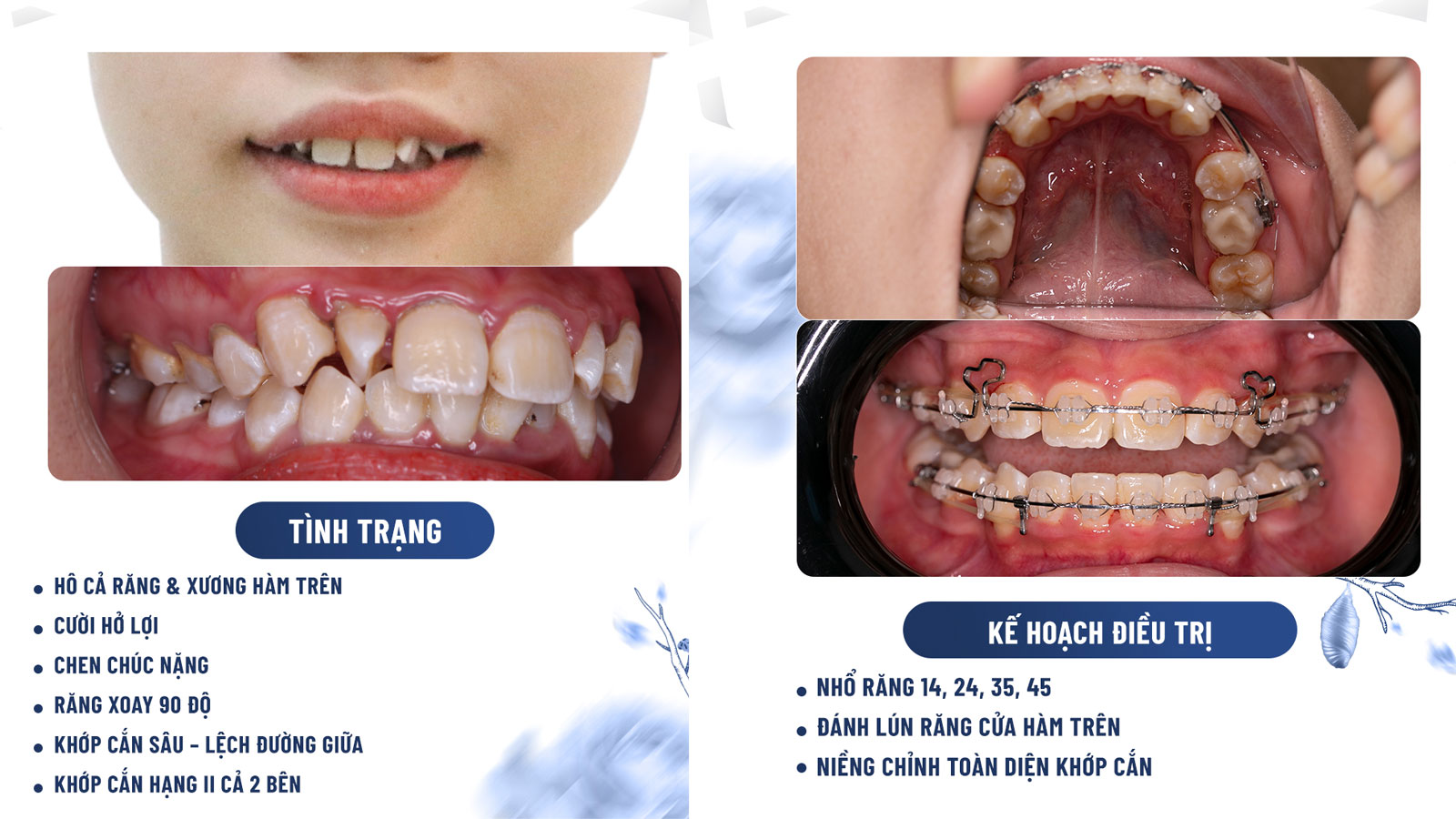 Khớp cắn hạng II là gì? Nhận biết thế nào? 