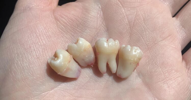 Vì sao không nên chờ răng rụng mới trồng?