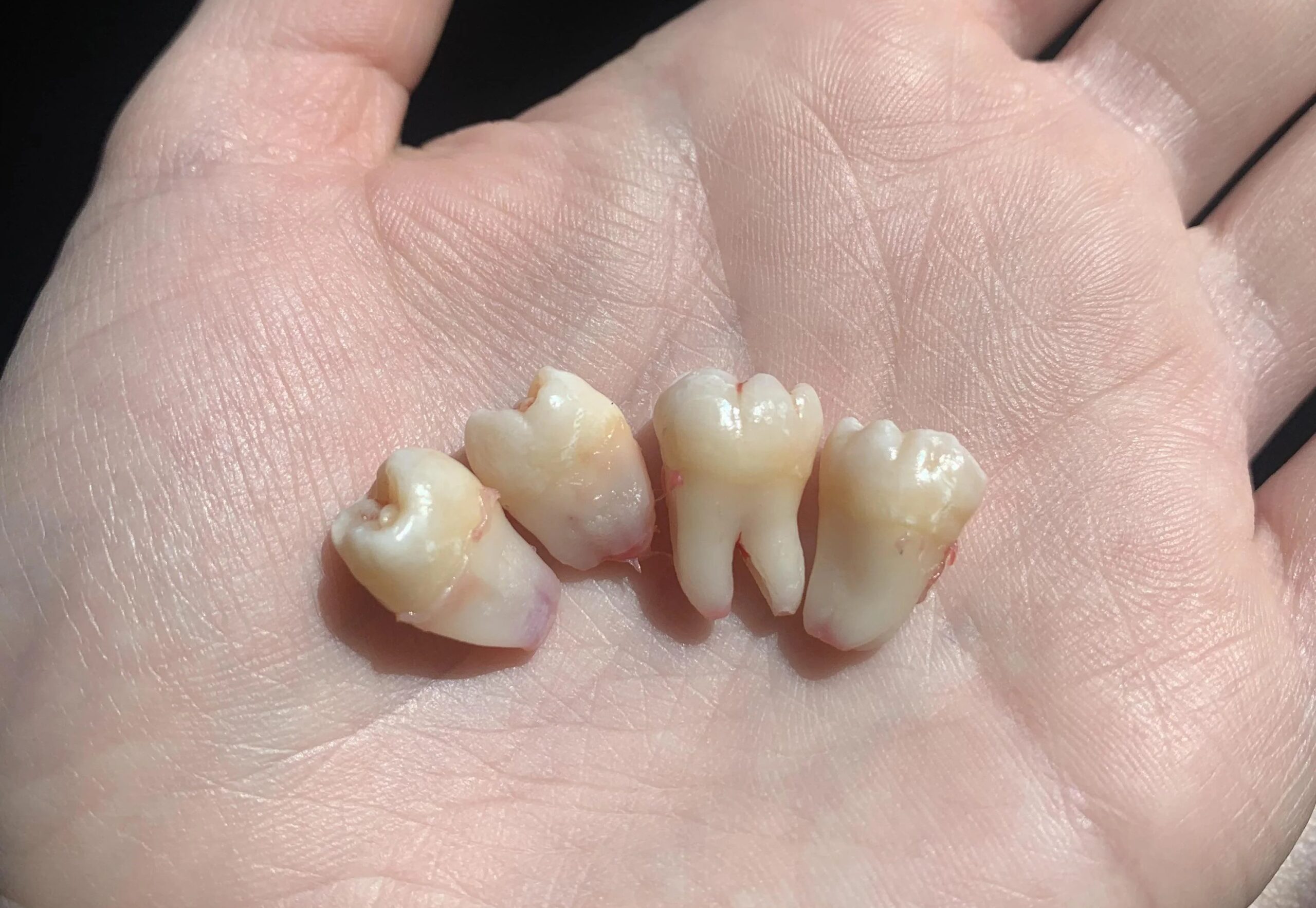 Vì sao không nên chờ răng rụng mới trồng?