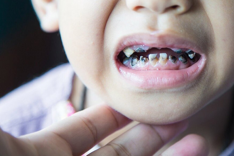 Đừng đợi “răng thay rồi sẽ hết” – vì có thể bạn đang chậm một bước!