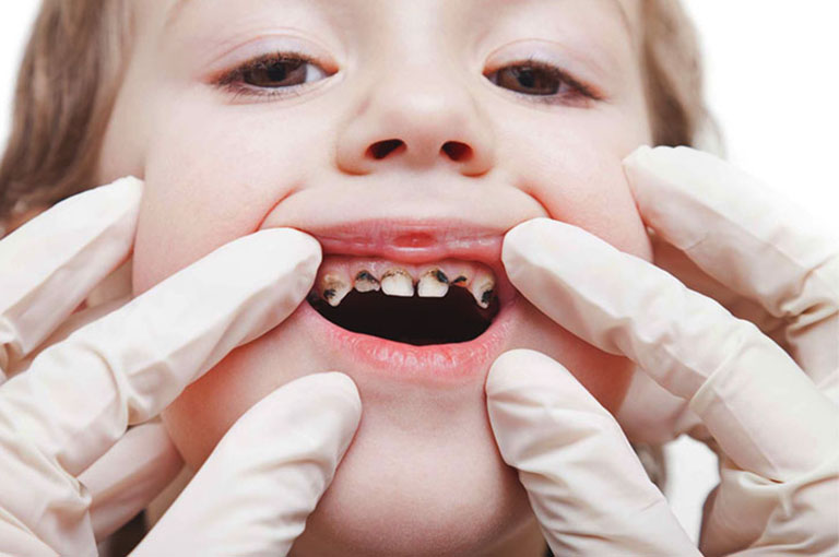 Điều trị sâu răng sữa tại Nha khoa Olympia – Không đau, không sợ, an toàn cho bé