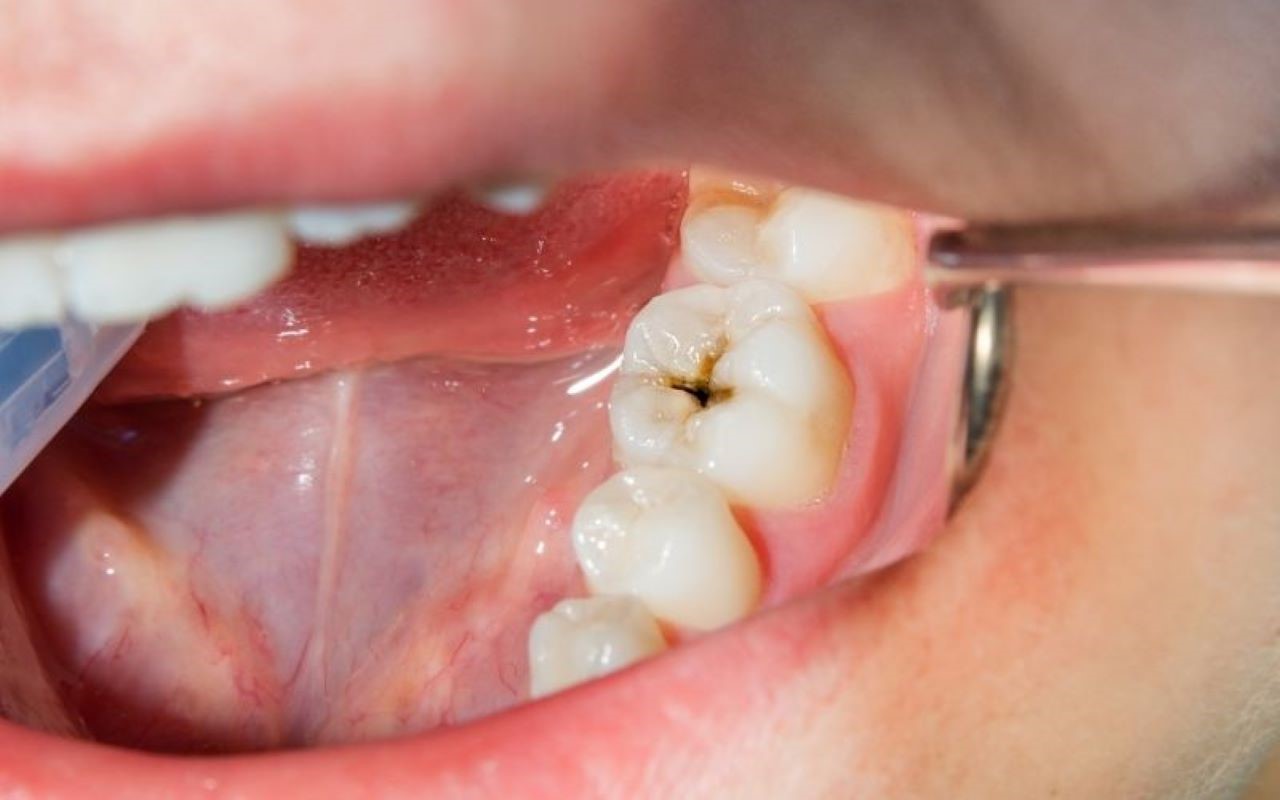 Vì sao nên chọn Nha khoa Olympia để phòng ngừa sâu răng?