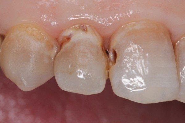 Trẻ bị sâu răng sữa có cần chữa không?