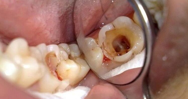 Nhổ răng sâu có đau không?