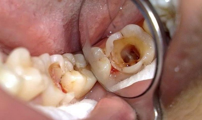 Nhổ răng sâu có đau không?