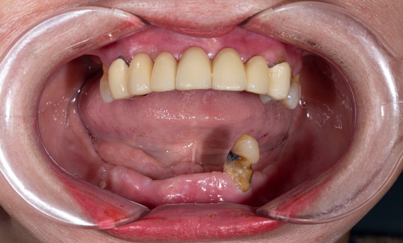 Tiêu xương nghiêm trọng (dưới 4–5mm chiều cao xương).