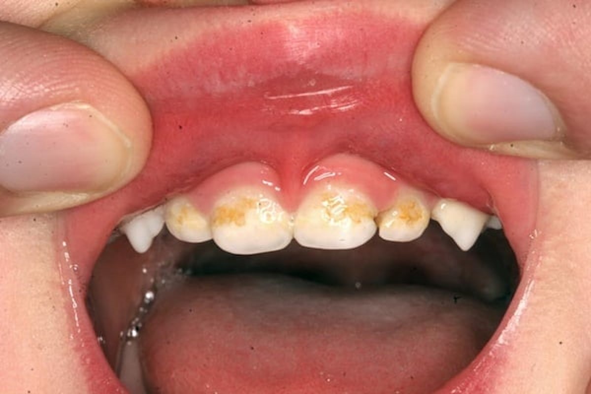 Cạo vôi răng cho trẻ em có cần thiết không? Bác sĩ trả lời thật lòng