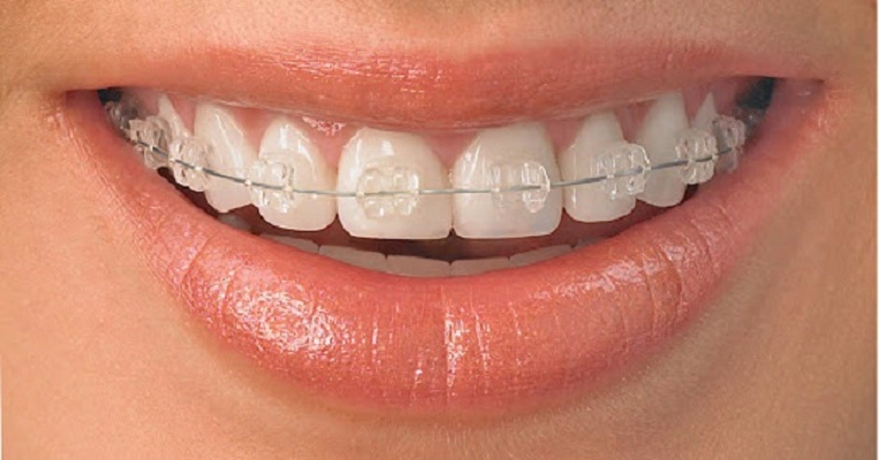 Ưu điểm nổi bật của niềng răng mắc cài sứ