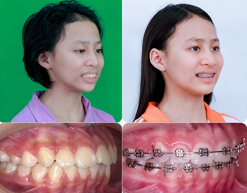 Niềng răng cho bé bị hô bằng mắc cài hay khay trong?