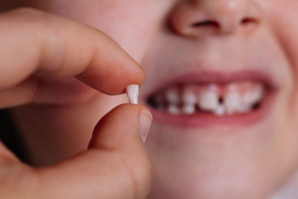 Răng sữa bị lung lay là hiện tượng sinh lý tự nhiên