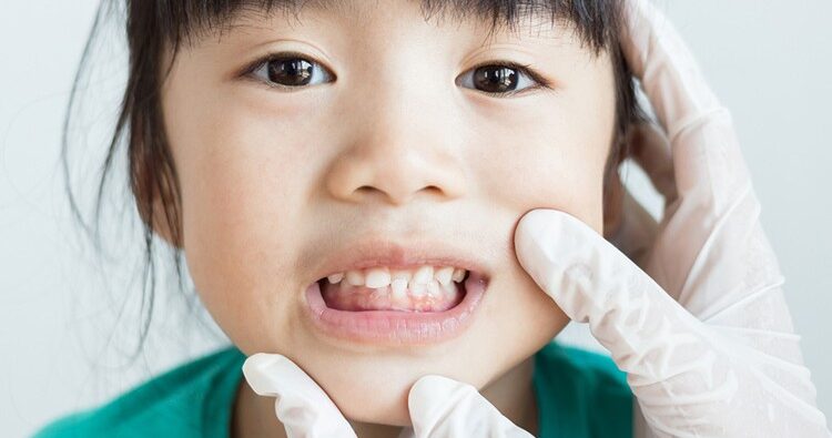 Tư vấn phòng ngừa lệch khớp cắn sớm – Cha mẹ cần làm gì?