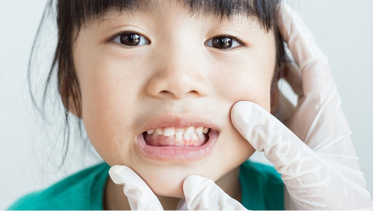 Tư vấn phòng ngừa lệch khớp cắn sớm – Cha mẹ cần làm gì?