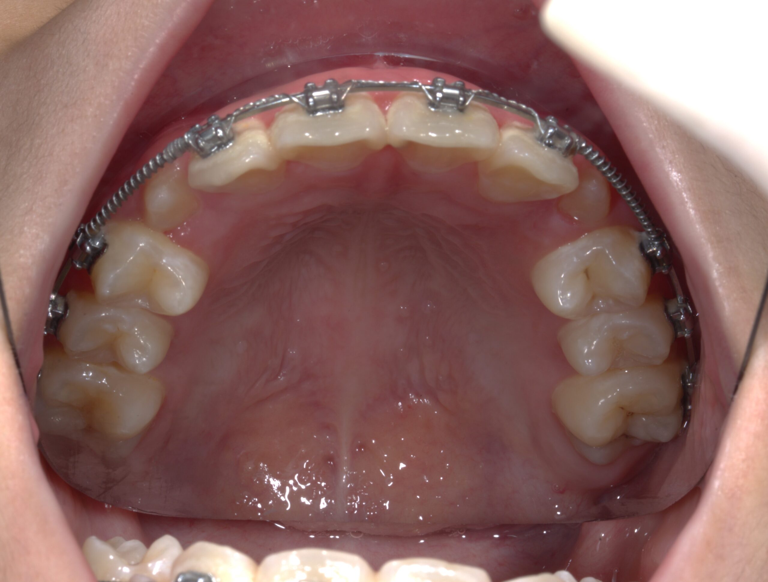 Niềng răng giúp trẻ có khớp cắn khỏe mạnh