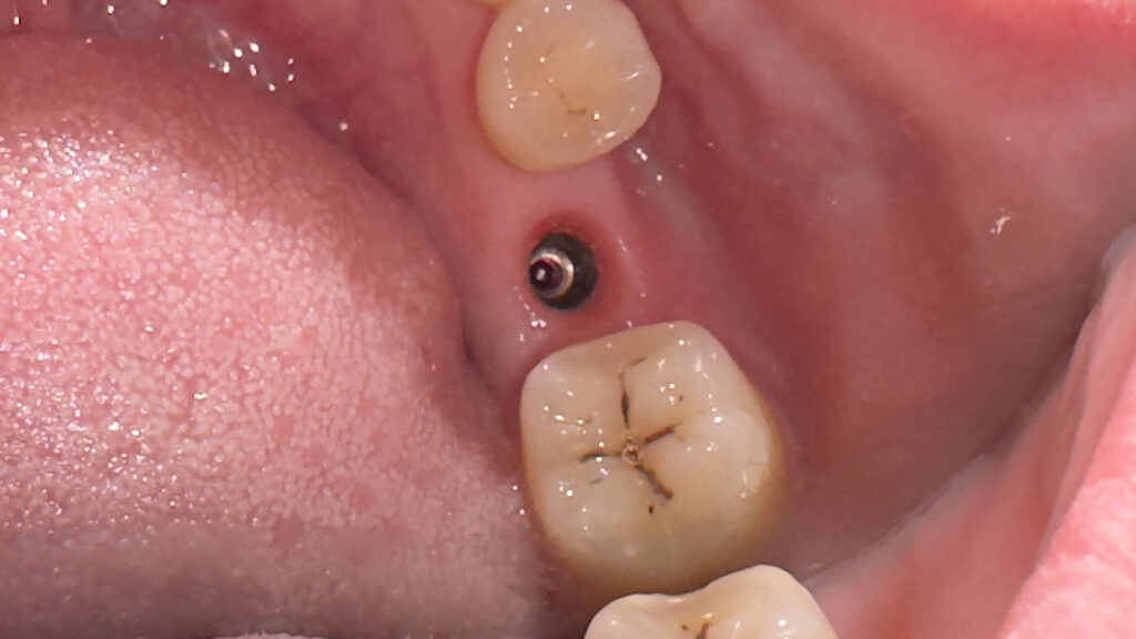 Mô mềm tạo seal sinh học – hàng rào đầu tiên ngăn vi khuẩn xâm nhập