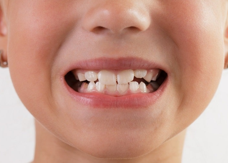 Dấu hiệu lệch khớp cắn ở trẻ em sớm