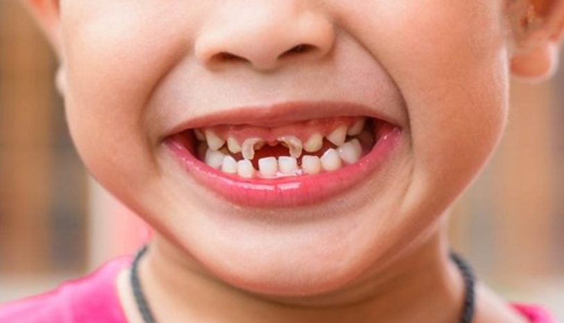 Sâu răng sữa ở trẻ là gì? Có nghiêm trọng không?