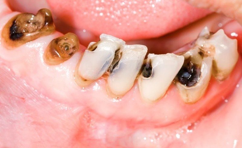 Dấu hiệu cảnh báo sâu răng sớm ở trẻ – cần khám ngay