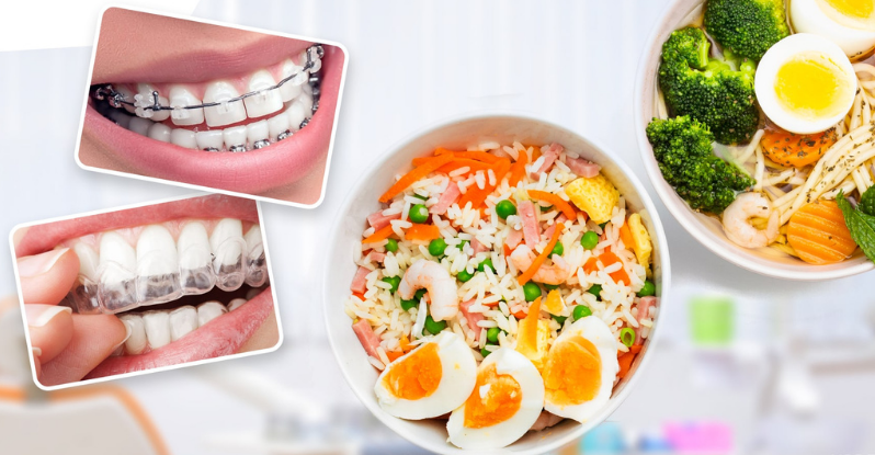 Vì sao chế độ ăn uống khi niềng răng lại quan trọng?