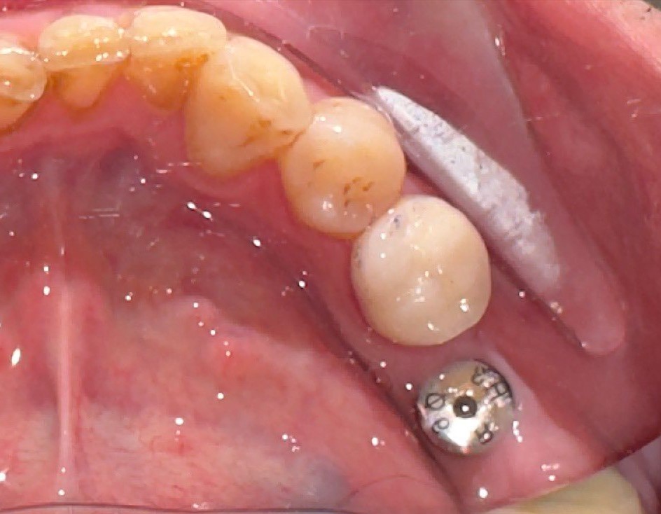 Abutment cá nhân hóa giúp hỗ trợ mô mềm tối ưu