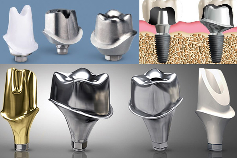 Abutment cá nhân hóa giúp tối ưu phục hình cho người mặt vuông